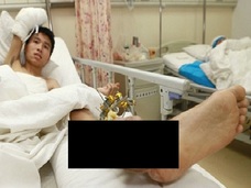 切断された手を、足首に縫合して温存 中国で行われた驚異の手術とは?