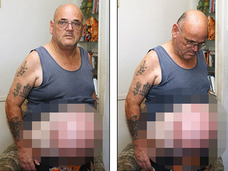腹が風船のように膨らみ続ける男 4回手術するも、原因不明=オーストラリア
