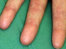 生まれつき指紋がない人間!? 世界でたった4家系のサンプルからわかった、人体の謎とは?