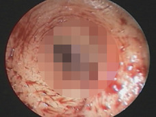 【閲覧注意】耳の中にウジ虫が湧いた女! 鼓膜近くでウネウネ皮膚を蝕む衝撃動画!!