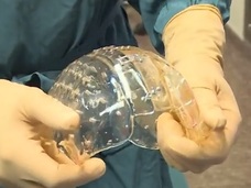 世界初・3Dプリンターで作った頭蓋骨の移植手術! 理想的なサイズでぴったりハマる!? 【動画閲覧注意】