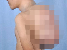 13kgの巨大腫瘍を背負っていた男! 大人4人分の輸血を伴う手術の末に……