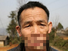 【閲覧注意】54年間、口が消えた男!? 狼に噛みちぎられた傷を再建へ =中国