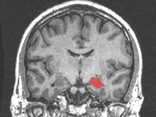 手術で心の中が見えるようになった女性 ― 人間は機能を失うと「超能力」が開花する!