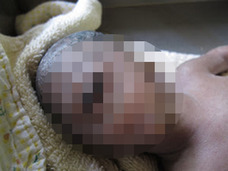 【閲覧注意】戦慄、生まれた我が子は一つ目だった…! 単眼症の原因と非情な現実