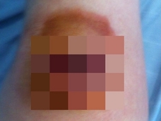 膝に友達の前歯がめり込んだまま、傷口を縫合されてしまったトホホな男とは?