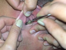 【閲覧注意】身の毛もよだつ、虫に寄生された人々の体験談9!