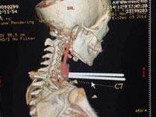 【閲覧注意】運が悪すぎる…!! 首に箸が2本突き刺さった少年=中国
