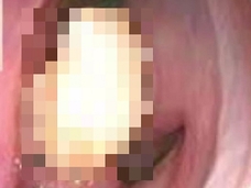 【閲覧注意】体内の奇妙な場所からニュッと歯が生えた人々