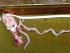 頭痛と痙攣に悩む11歳少年の脳から寄生虫! 中国の食肉に潜んでいた「芽殖孤虫」の恐怖!!
