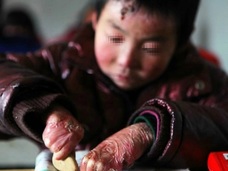全身の皮膚が剥がれ落ちる「蝶の子ども」 ― 8歳優等生の過酷すぎる暮らしとは!?