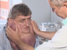 顎が胸まで伸びた男! 重さ6kg、完全切除へ=スロバキア
