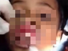 【閲覧注意】女児の歯茎から“生きた”ウジ虫が次々と…! ハイチで起きた蠢く悪夢