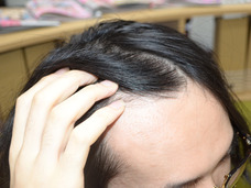 「顔半分がおでこ」の男が試した! 育毛剤の驚くべき効力!