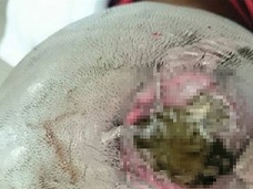 【衝撃】謎の頭痛に悩む男、ウジが頭を貪っていた!! 命拾いした驚愕の理由とは!?=ベトナム