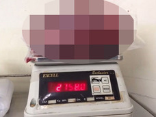 【閲覧注意】摘出された世界最大の腎臓がグロすぎる!! 放置すると恐ろしい「ADPKD」の末路=インド