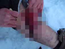 【閲覧注意】リアル・ブラックジャック! ロシアには自分で自分を手術する人間がいる!!