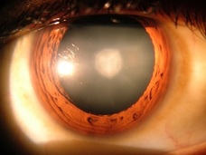 白内障が“手術なし”で治る時代へ!! 「ラノステロール」点眼薬がカギだった!(最新研究)