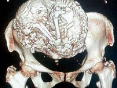 92歳老婆の腹から「ミイラ化した巨大胎児」 ― 剥がせぬミイラに医師が出した答え= チリ