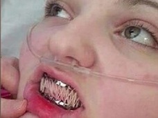 エーラス・ダンロス症候群 ― 身体がバラバラになる少女、口も縫い合わせる=イギリス