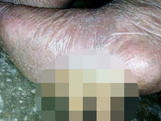 足の裏から3本のツノが生えた老女!! 現在も成長中、きっかけは◯◯のカケラ!?