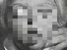 【閲覧注意】クルーゾン症候群 ― 顔面が歪み、眼球が飛び出る奇病