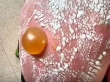 【閲覧注意?】日焼けでできた巨大水ぶくれがヤバすぎる!! 死をも招く恐怖の紫外線!!=米・オクラホマ