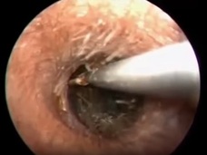 【閲覧注意】男の耳の穴で暮らす「大量のゴキブリ家族」を摘出!! 25匹の子連れだった!=中国