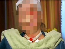 【超・閲覧注意】チンパンジーに顔を“むしり取られた”女!! 完全に崩壊した顔面が悲惨すぎる!