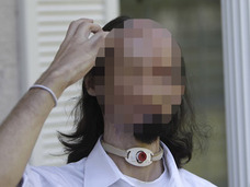 【閲覧注意】事故で「のっぺらぼう」になった男 ― 驚異の全顔面移植手術、全貌とは!?