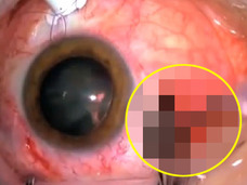 【閲覧注意】恐怖の「眼球パックリ」手術!! 目に刺さったガラス片を抜く方法とは!?