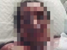 【閲覧注意】“漂白剤風呂”で全身ボロボロになった女!!=オーストラリア