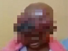 【閲覧注意】ぬいぐるみを抱えて泣き叫ぶ「顔面全体・腫瘍」の男児! 心が引き裂かれる奇病動画