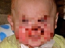 愛する我が子がチャッキーになっていく…! 恐怖の皮膚疾患「EBウイルス」と闘う子どもたち