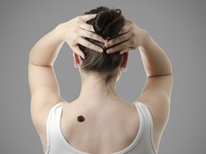右腕に●個以上ホクロがあると、皮膚ガンになる可能性が高い(最新研究)
