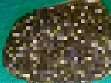 【トライポ閲覧注意】インド人女性の体内から11,950個の胆石出現! 医者も驚愕、異次元レベルのグロ画像…!