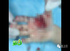 春節名物の爆竹が爆弾化!? 中国男児、誤爆で指8本吹き飛ばされる