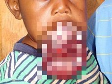 【閲覧注意】南アフリカの口裂け少年 ― 命を脅かす制御不能の唇