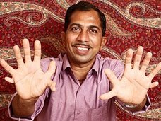 手足合わせて28本の指を持つ世界イチの多指症男! 「間違って指を切り落としそうになる」=インド