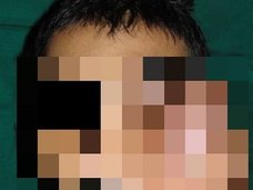 【閲覧注意】虫歯だと思ったら全然違った!? 急激に顔が腫れる難病とは?=インド