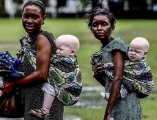5歳のアルビノ少女の手足を切断…! アフリカで横行するアルビノとの「エイズセックス」 と人身売買