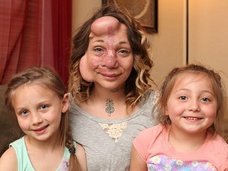 【閲覧注意】顔面に巨大風船を入れた女! 顔をボコボコに膨らませた切実な理由とは?=アメリカ