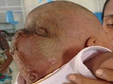 【閲覧注意】後頭部に“第二の頭”がついた赤ん坊! 頭蓋骨から中身がはみ出る「後頭骨脳ヘルニア」の恐怖