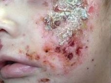 水の汚染が原因で恐怖の皮膚病が流行? 政府は否定・隠蔽で、カナダ先住民がブチギレ!