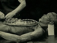 【閲覧注意】増加する胃腸が飛び出た乳児! 「腹壁破裂」ベビーとは?