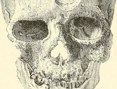 【超・閲覧注意】頭部が溶けた女 ― 合成麻薬クロコダイルで体中が壊死した人々