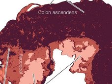 出血し壊死した大腸…O157にかかるとこうなる!?