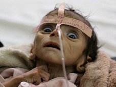 餓死する2日前の子どもの瞳が訴えかけるものとは? 骨と皮になった生後5カ月の赤ん坊は絶望を見て死んだ=イエメン