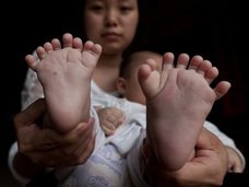 【閲覧注意】手足合わせて31本の指! 多指症世界記録を更新した赤ん坊がヤバい=中国