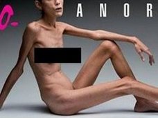 拒食症は感染症だった! 人間の心を蝕むバクテリアがいる(最新研究)